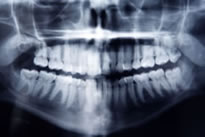 レントゲン写真例